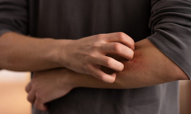 Red meat allergy (Alpha-Gel syndrome)